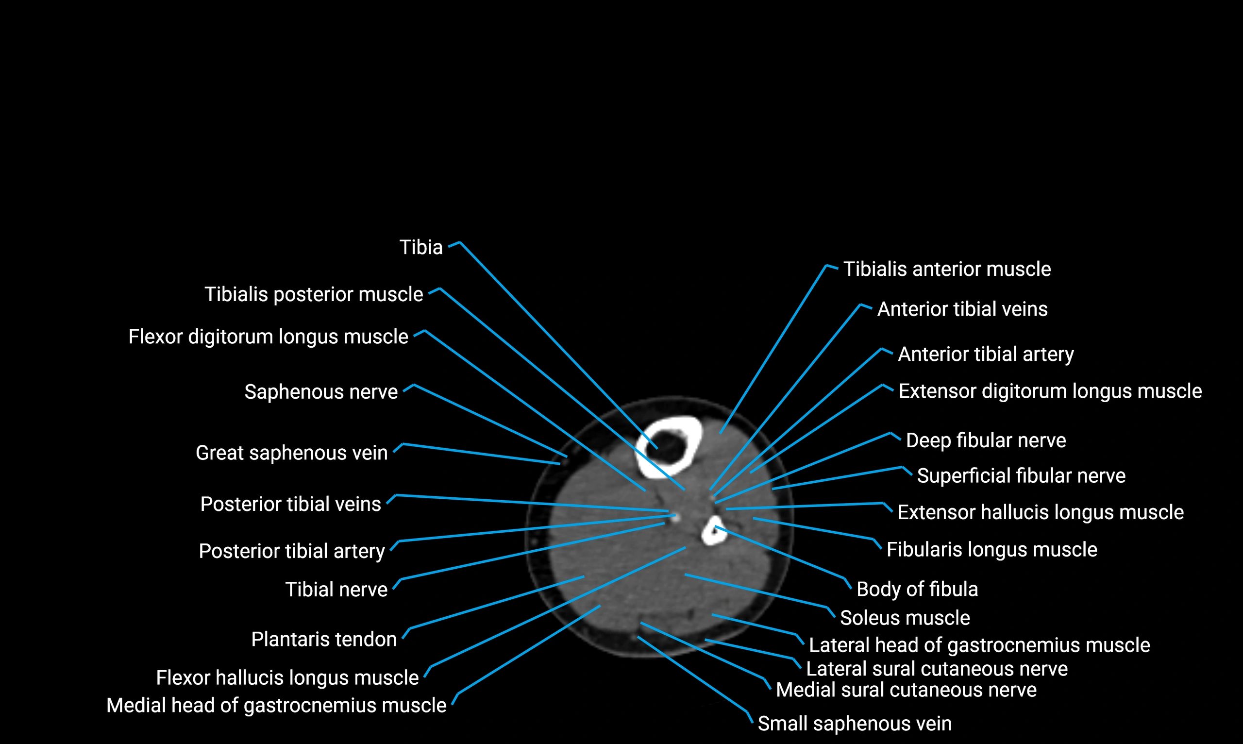 CT lower limb axial cross sectional anatomy labelled image 111 (2).webp